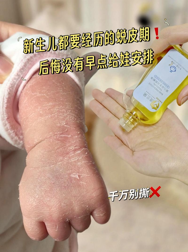 新生儿脱皮要怎么护理-第2张图片-郑州医学网