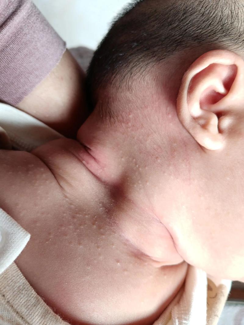 新生儿脖子闪了有哪些具体表现？家长该如何判断和处理？-第1张图片-郑州医学网