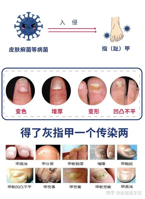 孕期治疗灰指甲安全吗？药物会影响胎儿发育吗？-第2张图片-郑州医学网