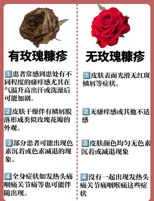 孕期玫瑰糠疹怎么护理-第3张图片-郑州医学网 孕期玫瑰糠疹怎么护理-第3张图片-郑州医学网