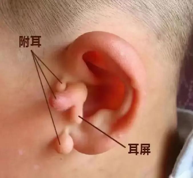 新生儿附耳形成是孕期发育异常导致的吗？与遗传或环境因素有关吗？-第3张图片-郑州医学网