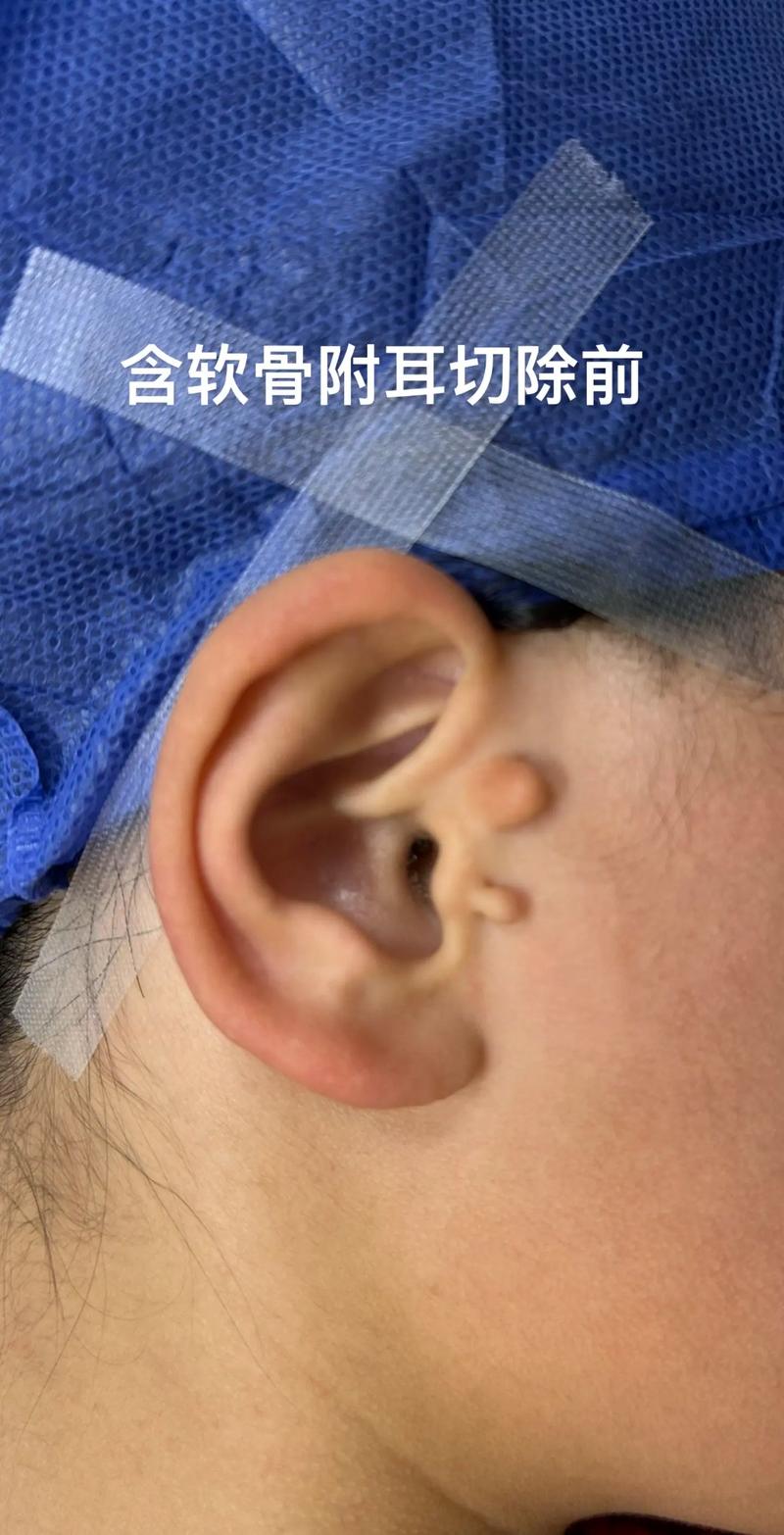 新生儿附耳形成是孕期发育异常导致的吗？与遗传或环境因素有关吗？-第2张图片-郑州医学网