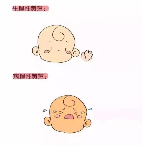 新生儿黄疸眼睛发黄图片能判断病情严重程度吗？-第2张图片-郑州医学网