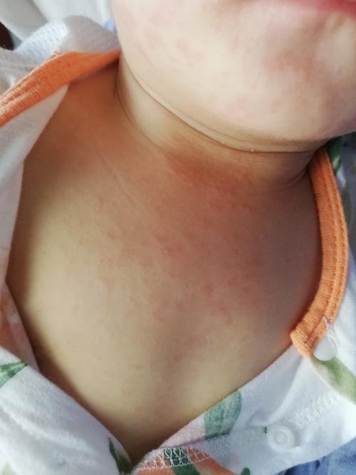 新生儿感冒的症状表现有哪些？家长该如何区分与普通感冒的差异？-第1张图片-郑州医学网