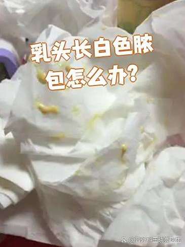 孕期乳头出现白色分泌物是正常现象还是异常信号？该如何区分和处理？-第1张图片-郑州医学网