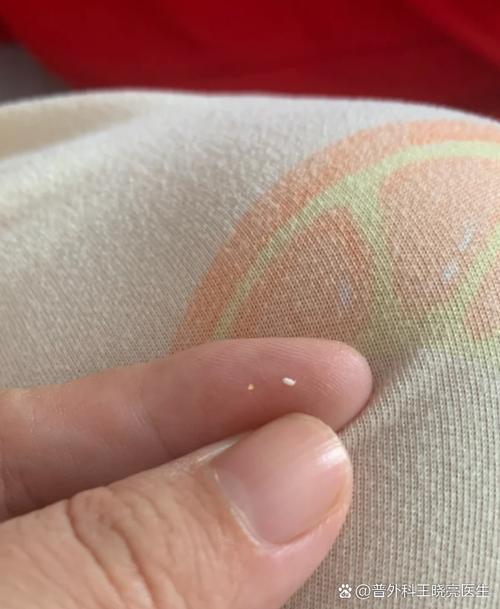 孕期乳头出现白色分泌物是正常现象还是异常信号？该如何区分和处理？-第2张图片-郑州医学网