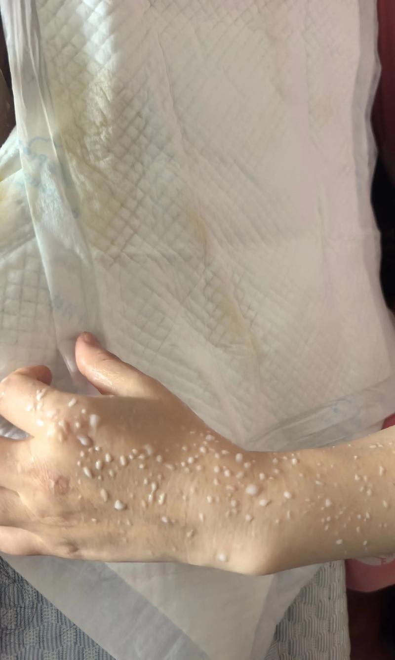 孕期乳头出现白色分泌物是正常现象还是异常信号？该如何区分和处理？-第3张图片-郑州医学网