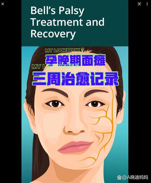 孕期面瘫究竟是谁在捣鬼？激素变化还是病毒感染作祟？-第1张图片-郑州医学网