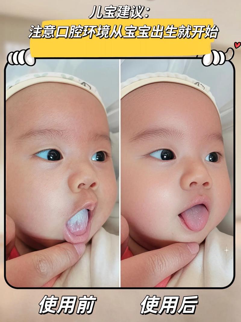 新生儿口腔清洁怎么做？有哪些注意事项需要牢记？-第2张图片-郑州医学网