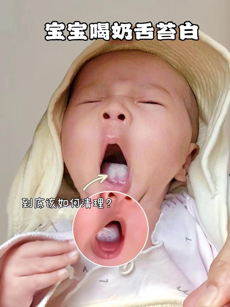 新生儿口腔清洁怎么做？有哪些注意事项需要牢记？-第3张图片-郑州医学网