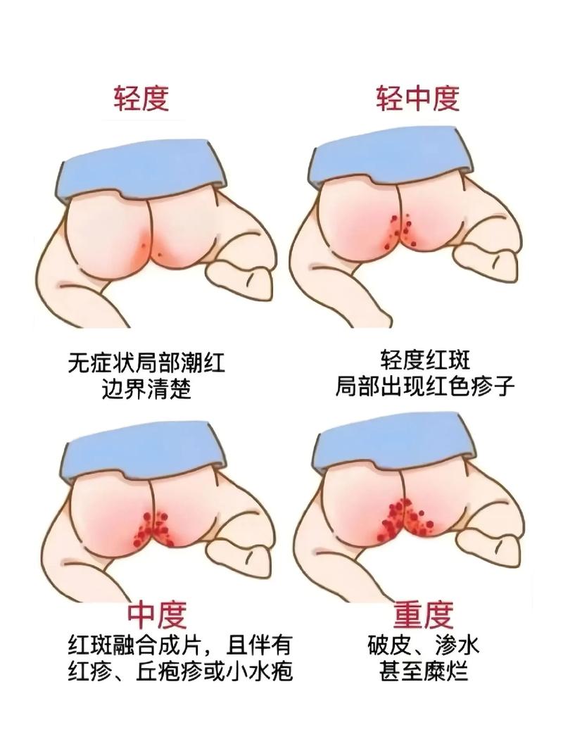 新生儿全身通红是正常生理现象还是疾病信号？需关注哪些伴随症状？-第1张图片-郑州医学网