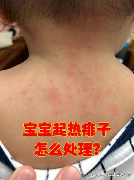 新生儿内热有哪些典型症状？附图片对照详解如何判断？-第2张图片-郑州医学网