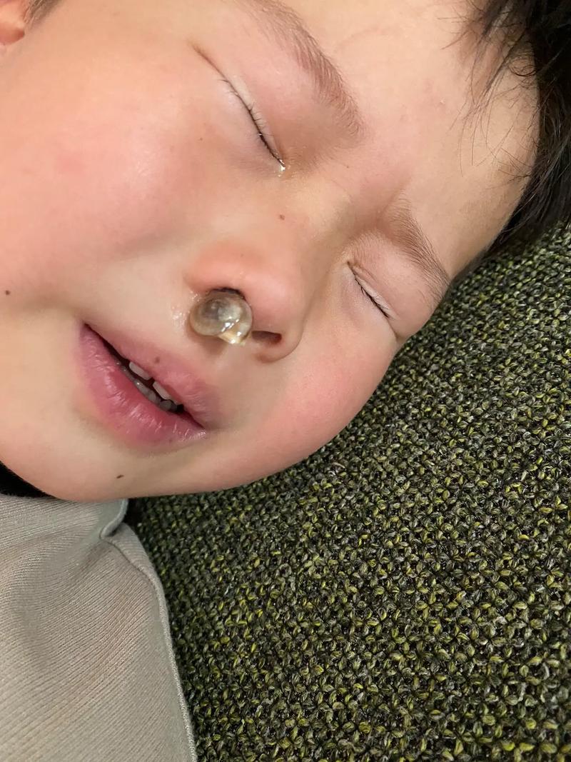 新生儿鼻孔里白色粘稠是正常分泌物还是异常信号？-第3张图片-郑州医学网