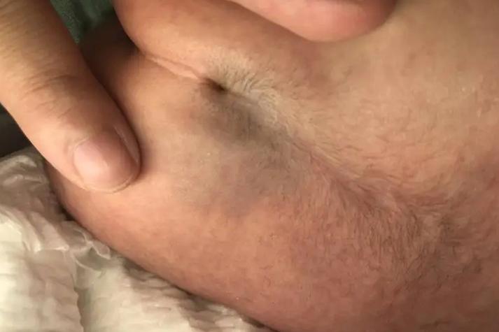 新生儿后背胎毛图片是正常现象吗？需要处理吗？-第2张图片-郑州医学网