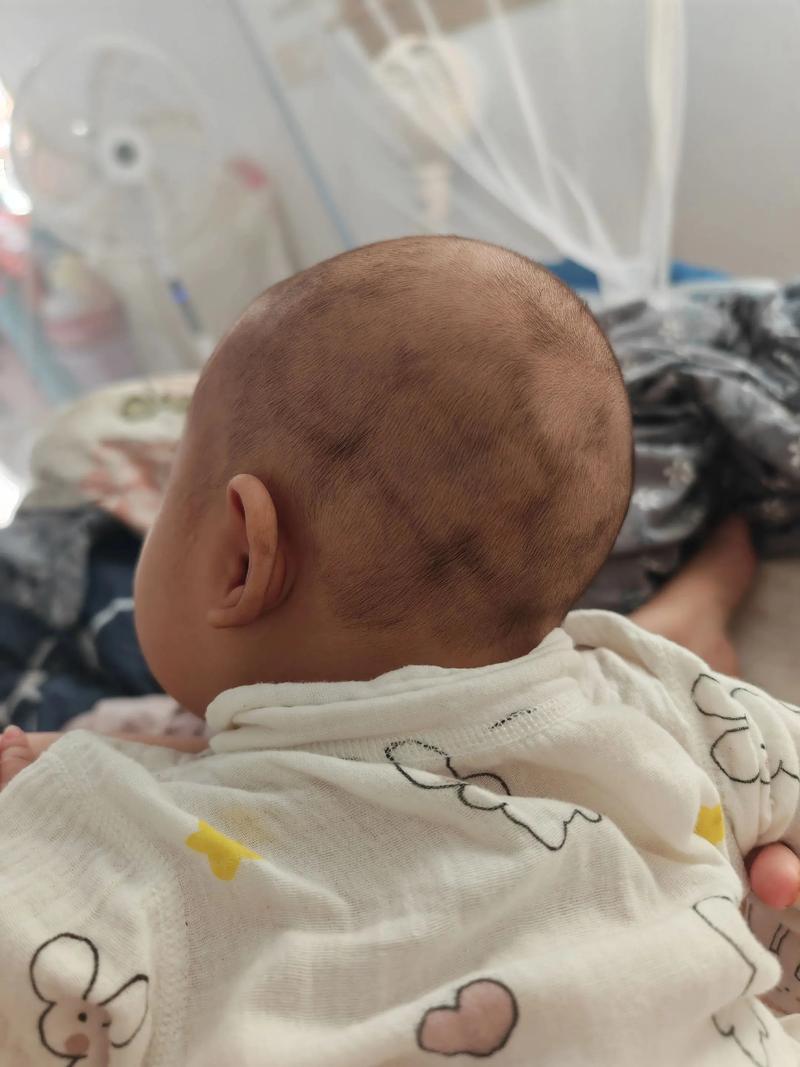 新生儿后背胎毛图片是正常现象吗？需要处理吗？-第3张图片-郑州医学网