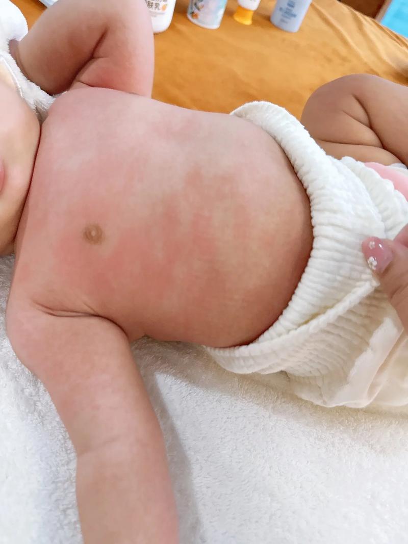 新生儿出现母乳蛋白过敏症状，妈妈饮食该如何调整才能继续哺乳？-第2张图片-郑州医学网