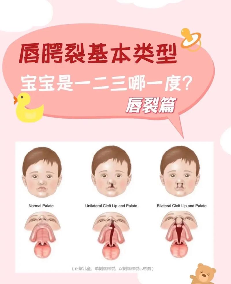 孕期兔唇究竟是如何形成的？遗传、环境因素与孕期营养不足共同作用下的深层原因是什么？-第2张图片-郑州医学网