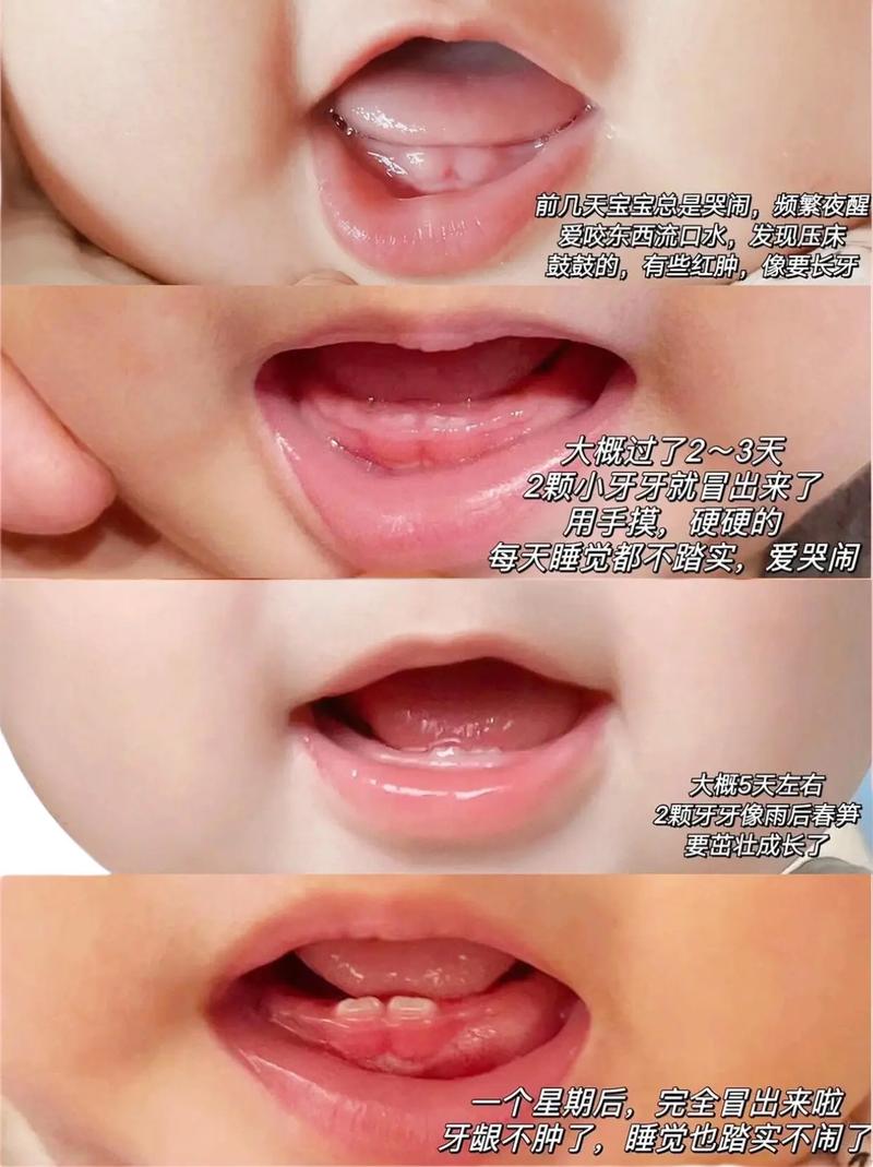 新生儿牙龈正常状态是怎样的？标准牙龈图片显示什么特征？-第1张图片-郑州医学网