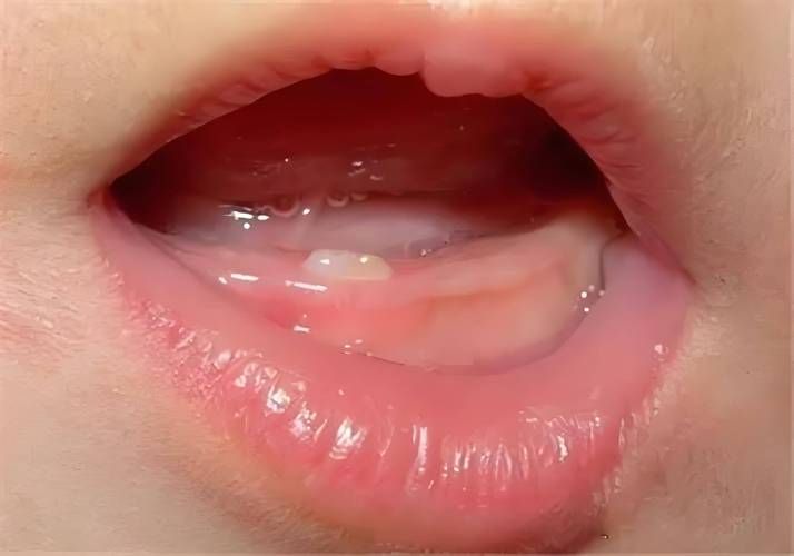 新生儿牙龈正常状态是怎样的？标准牙龈图片显示什么特征？-第2张图片-郑州医学网