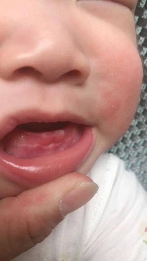 新生儿牙龈正常状态是怎样的？标准牙龈图片显示什么特征？-第3张图片-郑州医学网