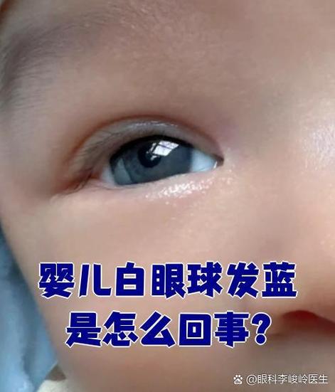 新生儿巩膜为什么是蓝灰色的？正常还是异常？何时会变成白色？-第1张图片-郑州医学网