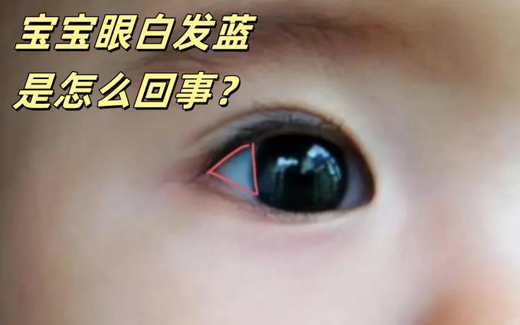 新生儿巩膜为什么是蓝灰色的？正常还是异常？何时会变成白色？-第2张图片-郑州医学网