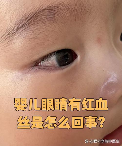 新生儿巩膜为什么是蓝灰色的？正常还是异常？何时会变成白色？-第3张图片-郑州医学网