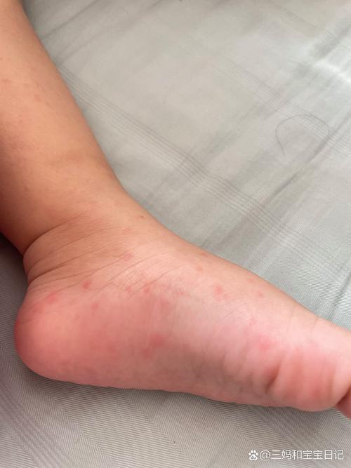 儿童血液病早期症状隐匿，家长该如何识别这些容易被忽略的危险信号？-第1张图片-郑州医学网