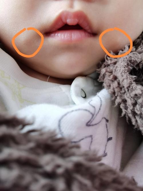 新生儿嘴唇下面肉凸起-第2张图片-郑州医学网