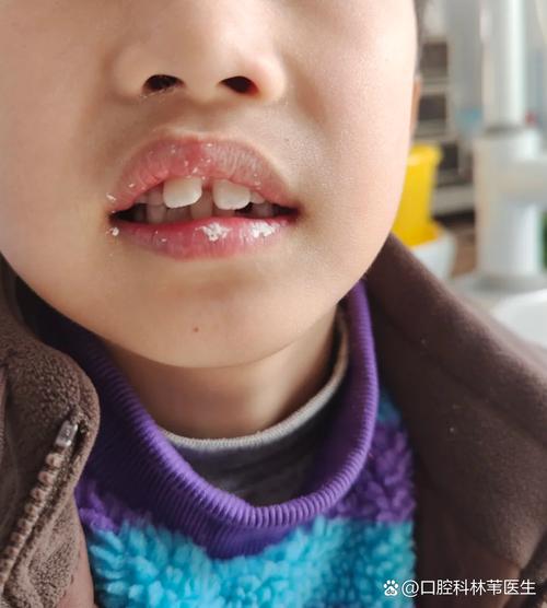 新生儿嘴唇下面肉凸起-第1张图片-郑州医学网