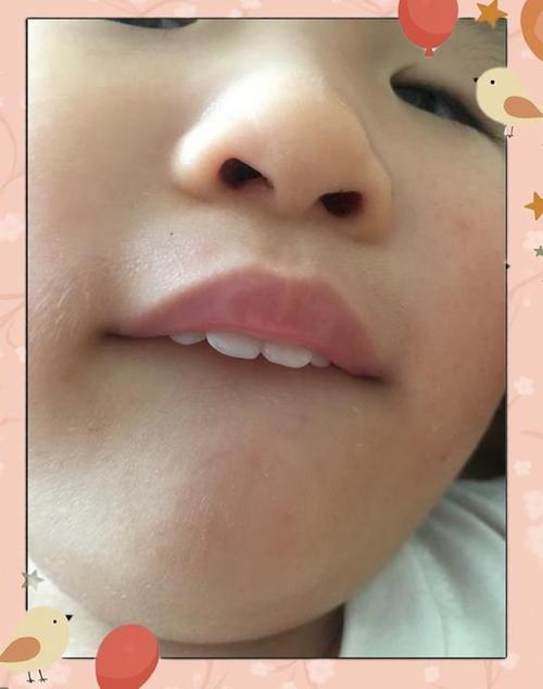 新生儿嘴唇下面肉凸起-第3张图片-郑州医学网
