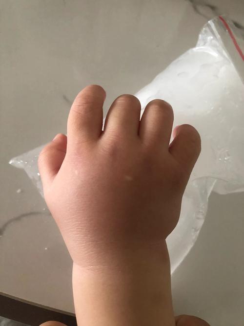 儿童手指关节肿大图片，是正常发育还是疾病的警示信号？-第1张图片-郑州医学网