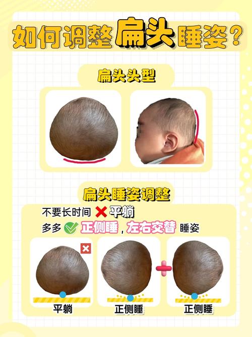 新生儿睡扁头怎么办？有哪些科学方法能有效预防？-第2张图片-郑州医学网