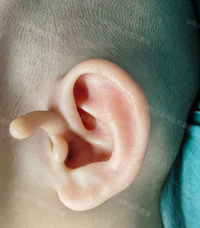 新生儿出生耳朵上有毛是正常现象还是健康异常？-第1张图片-郑州医学网