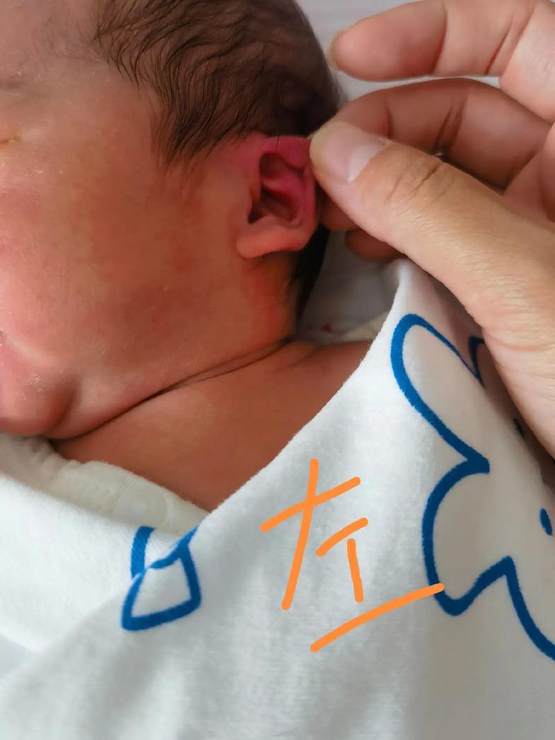 新生儿出生耳朵上有毛是正常现象还是健康异常？-第2张图片-郑州医学网