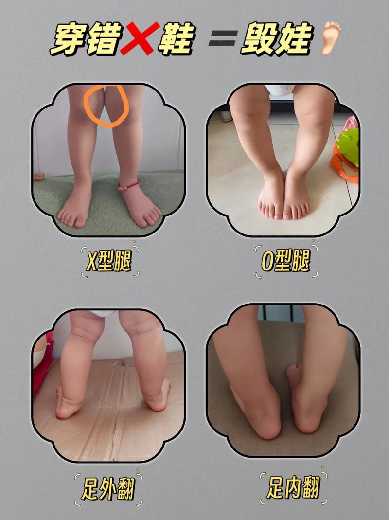 新生儿脚外翻矫正方法有哪些？不同矫正方式适用哪些情况？-第2张图片-郑州医学网