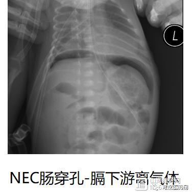 新生儿肠穿孔的存活比例究竟有多高？哪些因素会影响他们的生存几率？-第1张图片-郑州医学网