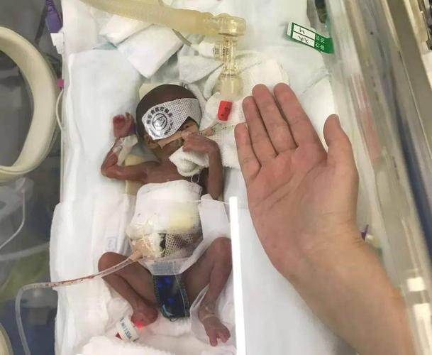 新生儿肠穿孔的存活比例究竟有多高？哪些因素会影响他们的生存几率？-第2张图片-郑州医学网