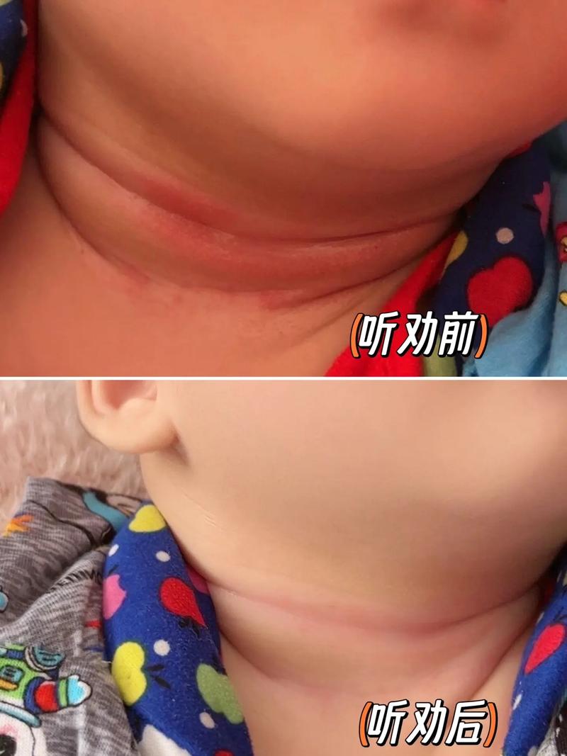 新生儿后脖子红色斑块是胎记还是疾病？需要治疗吗？-第1张图片-郑州医学网