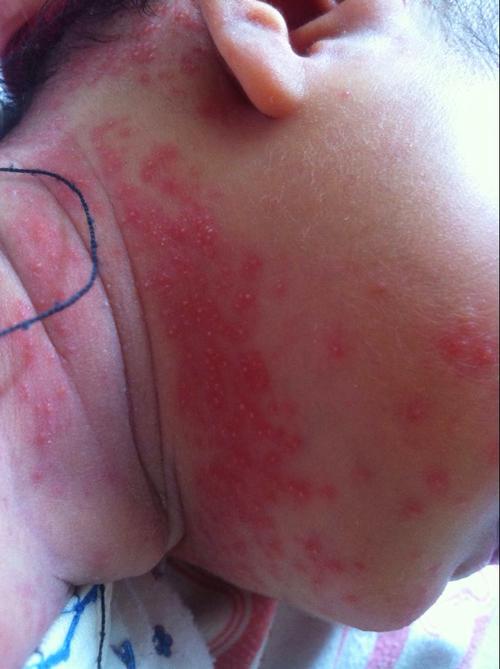 新生儿后脖子红色斑块是胎记还是疾病？需要治疗吗？-第2张图片-郑州医学网