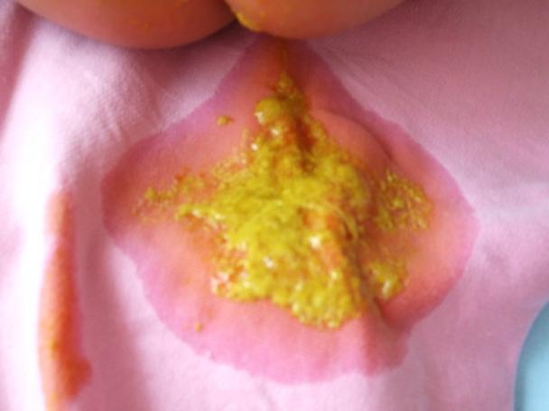 新生儿大便出现血丝和粘液是何原因？需要立即就医还是可在家观察？-第3张图片-郑州医学网