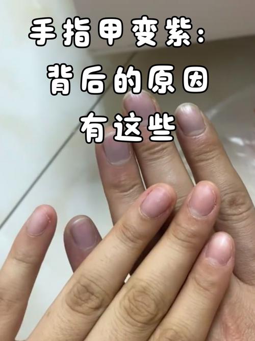 新生儿指甲发紫红是缺氧还是血液循环异常？附图片对比分析-第1张图片-郑州医学网