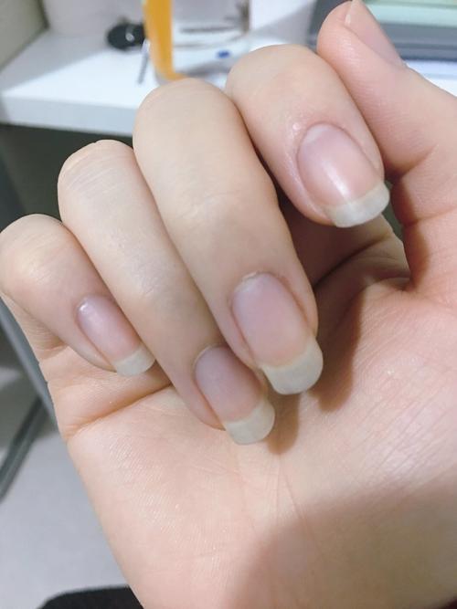 新生儿指甲发紫红是缺氧还是血液循环异常？附图片对比分析-第2张图片-郑州医学网