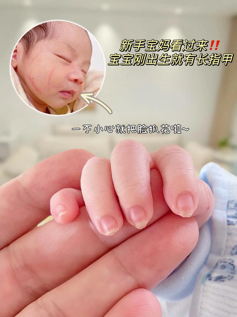 新生儿指甲正常图片是什么样？红润还是苍白？长度如何修剪才安全？-第1张图片-郑州医学网