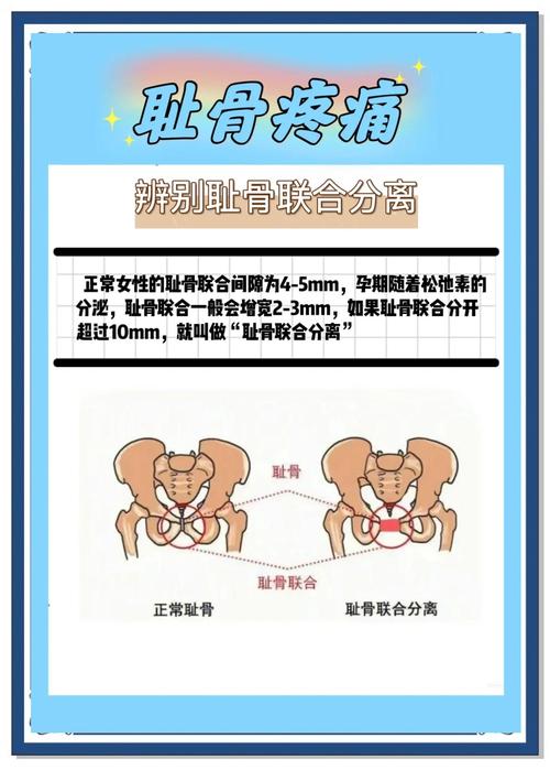 孕期耻骨疼到坐立难安？到底该怎么科学缓解才安全有效？-第2张图片-郑州医学网