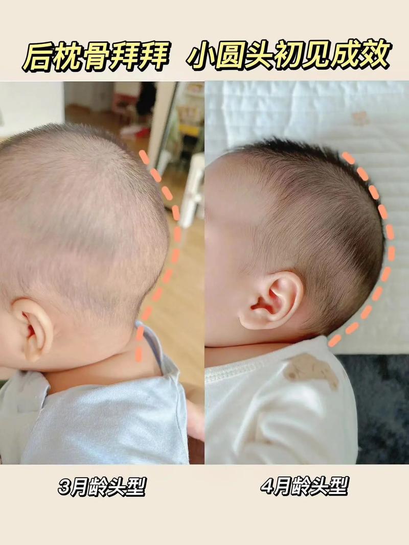 新生儿头后部骨头突出是正常现象还是异常表现？需要警惕哪些疾病风险？-第1张图片-郑州医学网