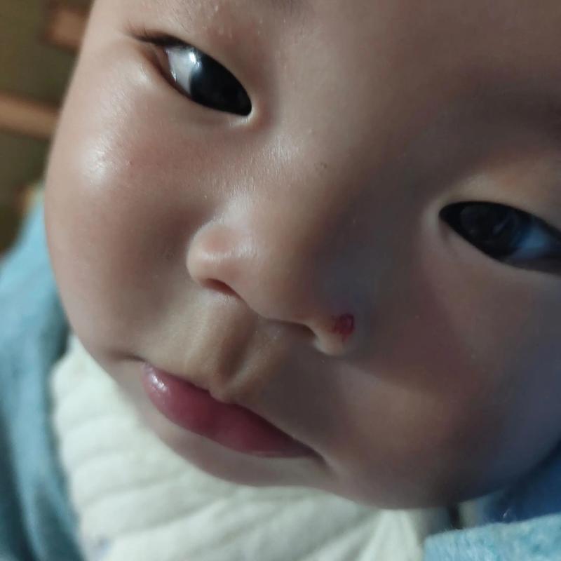 新生儿鼻粘膜损伤图片显示什么症状?如何正确处理和预防?-第1张图片-郑州医学网 新生儿鼻粘膜损伤图片显示什么症状?如何正确处理和预防?-第1张图片-郑州医学网