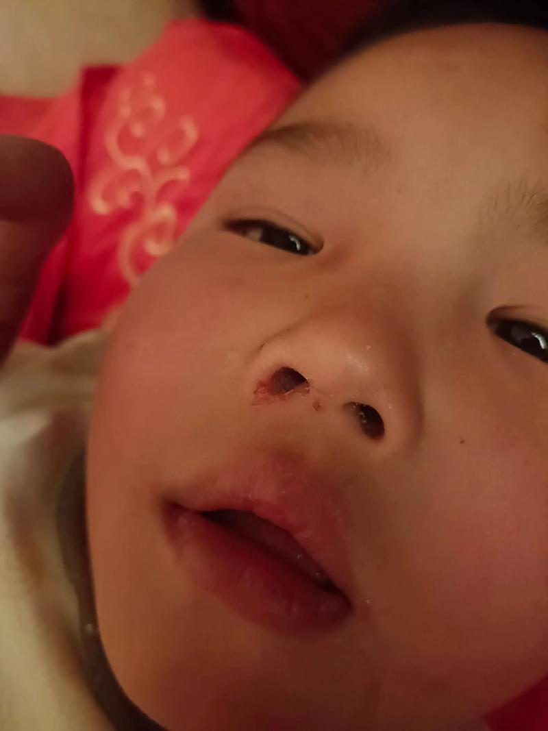 新生儿鼻粘膜损伤图片显示什么症状?如何正确处理和预防?-第3张图片-郑州医学网 新生儿鼻粘膜损伤图片显示什么症状?如何正确处理和预防?-第3张图片-郑州医学网