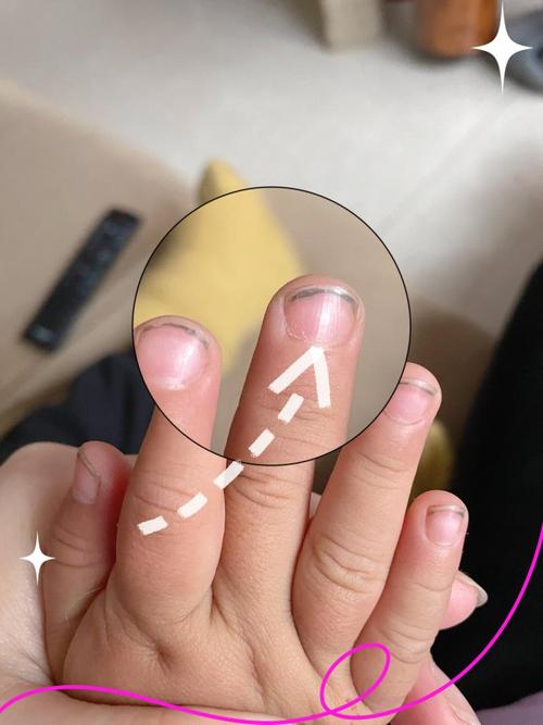 先心病新生儿指甲颜色异常意味着什么?是否与心脏病变程度相关?-第1张图片-郑州医学网 先心病新生儿指甲颜色异常意味着什么?是否与心脏病变程度相关?-第1张图片-郑州医学网