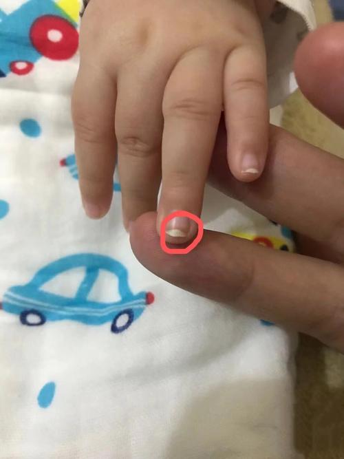 先心病新生儿指甲颜色异常意味着什么?是否与心脏病变程度相关?-第2张图片-郑州医学网 先心病新生儿指甲颜色异常意味着什么?是否与心脏病变程度相关?-第2张图片-郑州医学网
